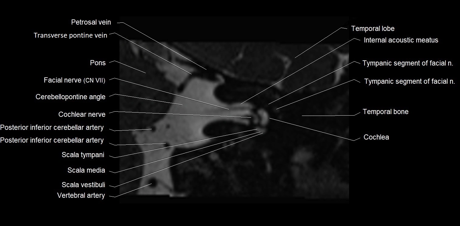 Internal auditory meatus (IAM) axial cross sectional anatomy image 9.webp